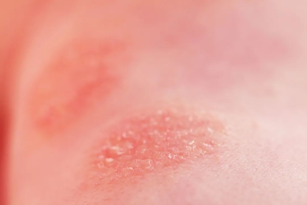 皮肤瘙痒高发期，试试中医